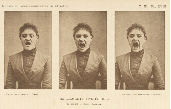 Baillements hystériques, plate XVIII. Three photos in a series showing a hysterical woman yawning.